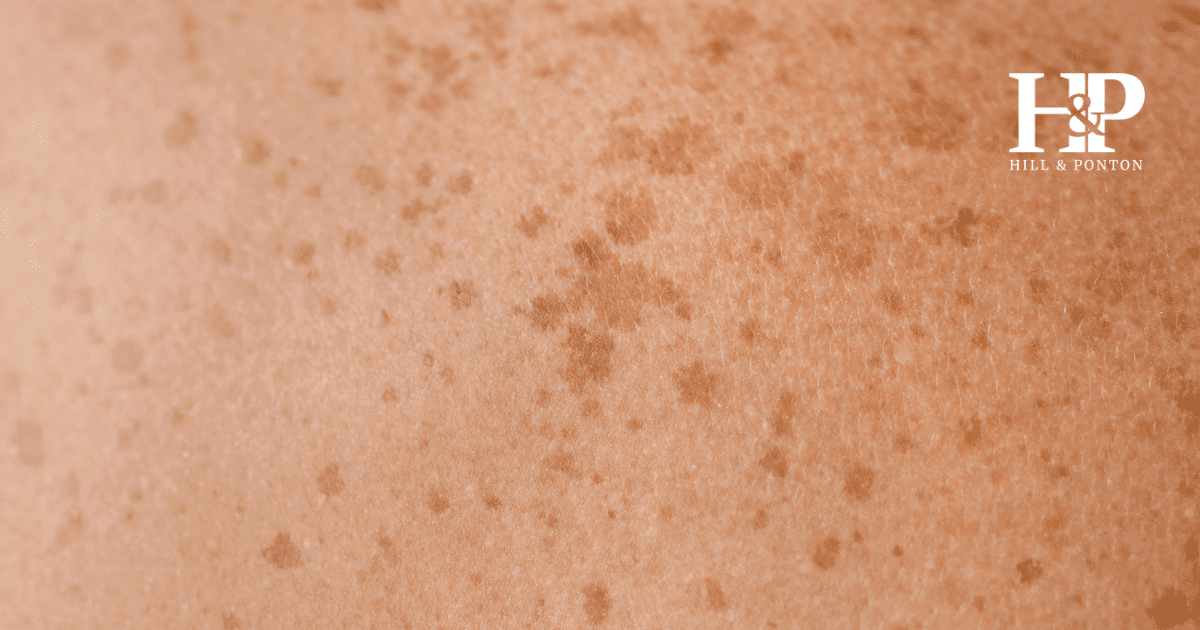 Close up of skin cancer