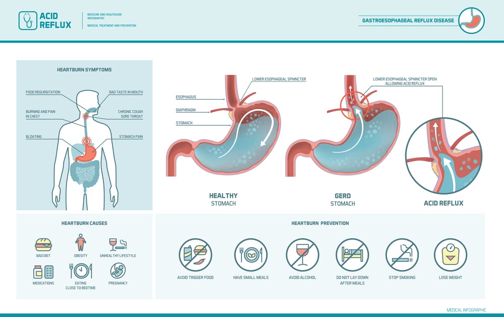 Acid reflux, heartburn and gerd infographic with stomach medical illustration, symptoms, causes and prevention