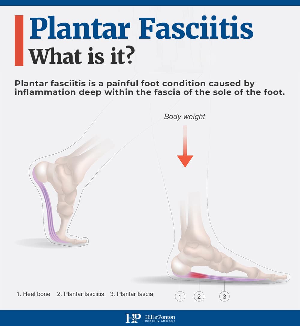 VA Disability Ratings for Plantar Fasciitis | Hill & Ponton, P.A.