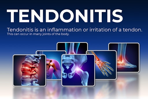 va disability rating tendonitis