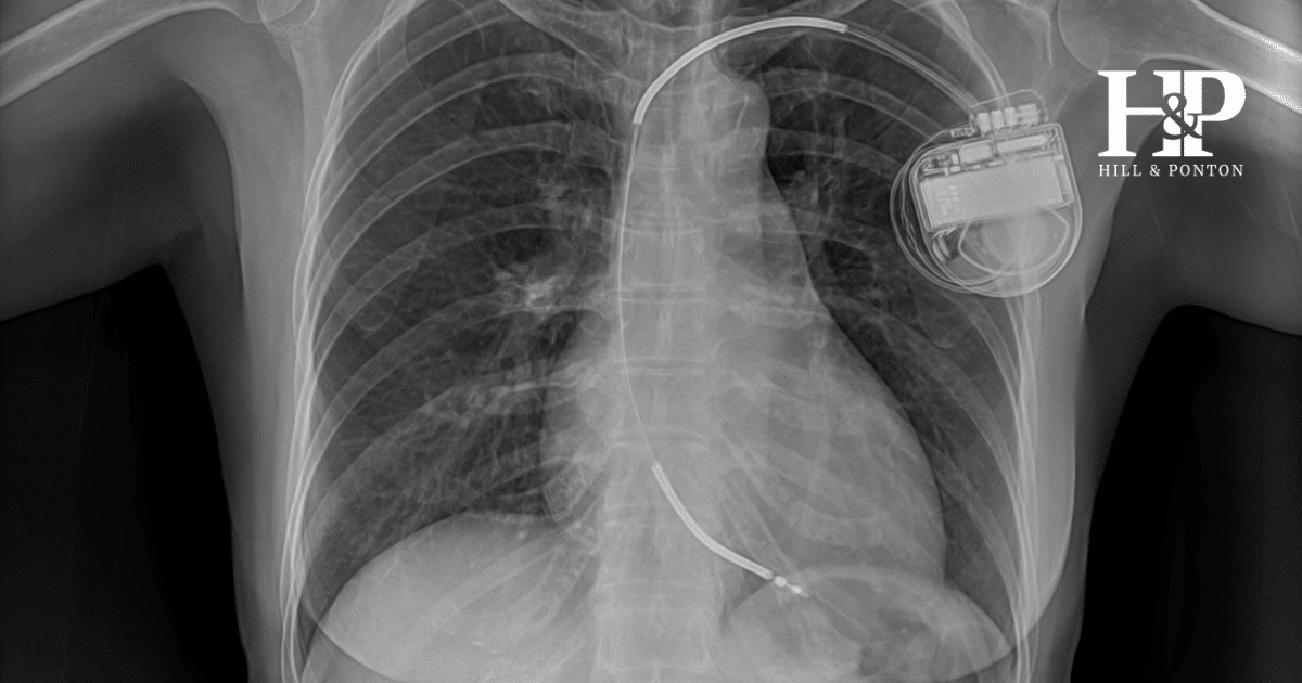 Pacemaker VA Rating